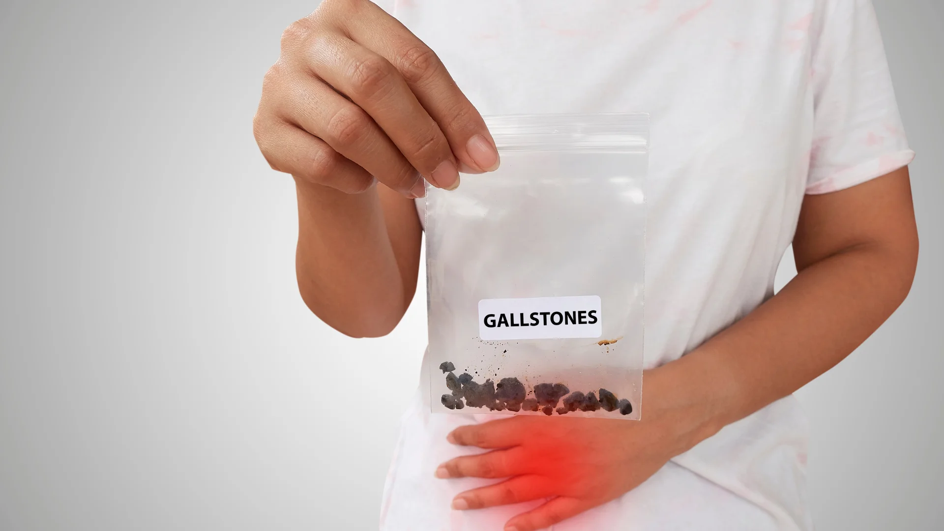 Gallstones